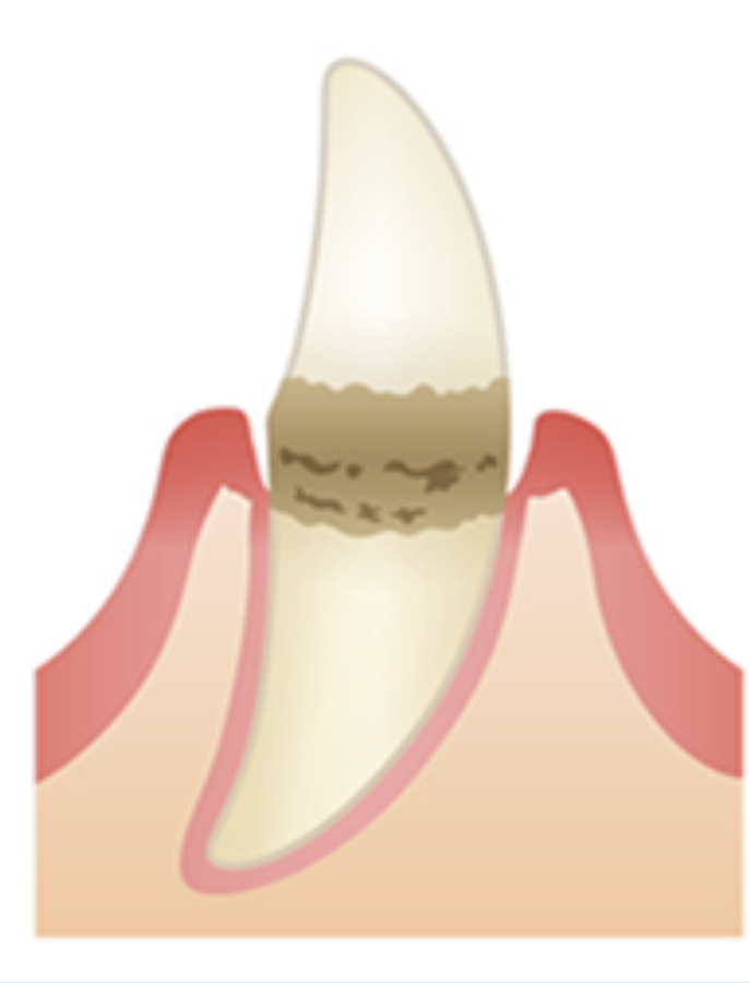 軽度歯周病を表す画像